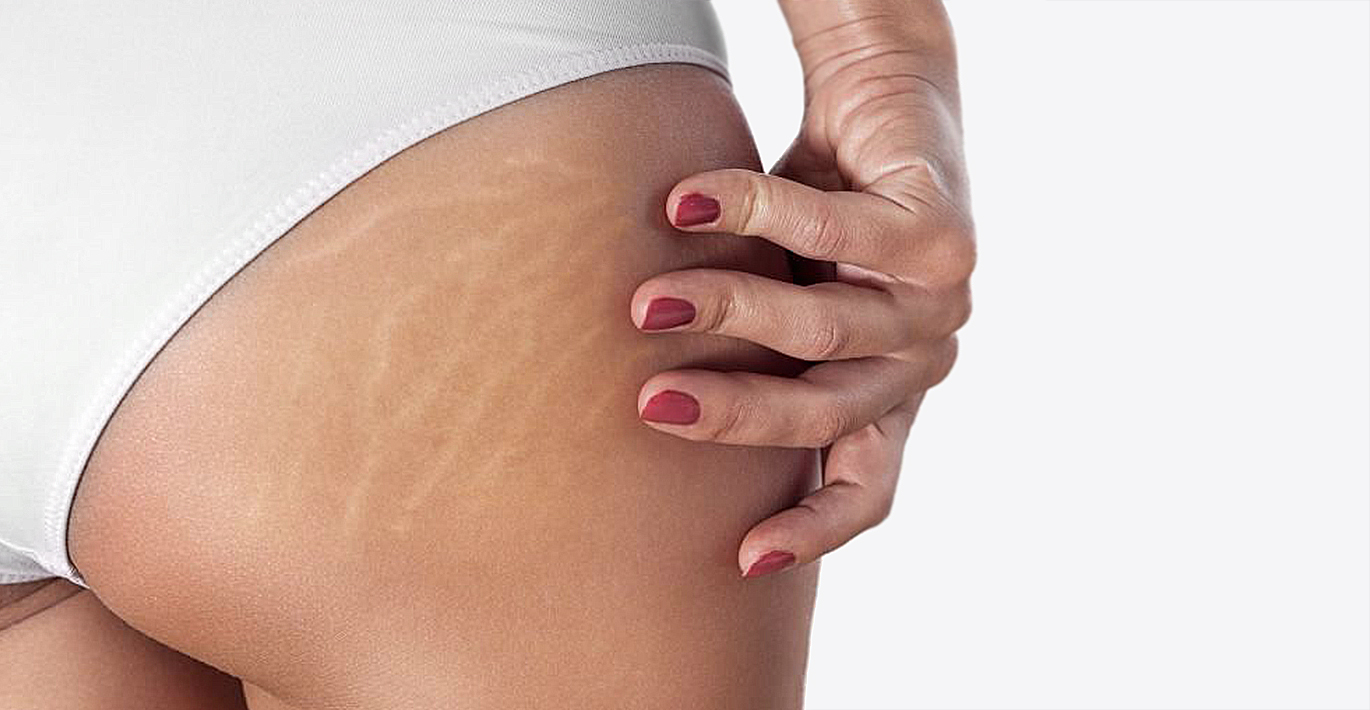 sovremennye-metody-udaleniya-rastyazhek-lazernaya-shlifovka-i-alternativnye-resheniya-2